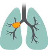 Squamous cell carcinomas