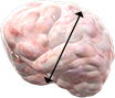 SD: Failure to observe CR or PR, but no PD